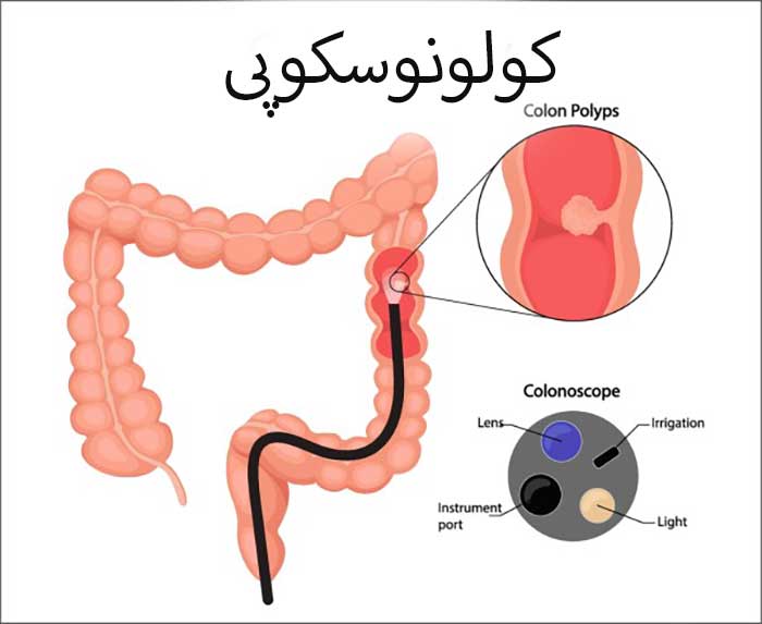 کولونوسکوپی