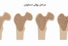 پوکی استخوان
