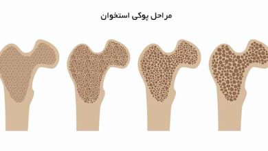 پوکی استخوان
