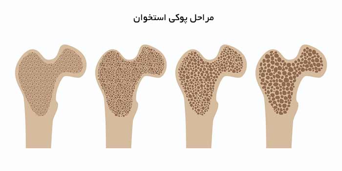 آموزشی پوکی استخوان