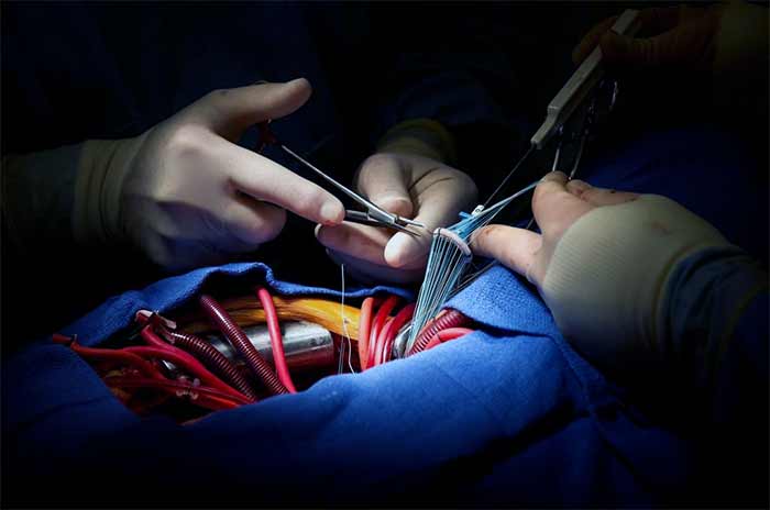 به هوش آمدن عمل قلب باز