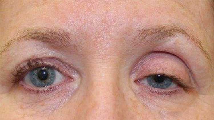 عوارض بوتاکس